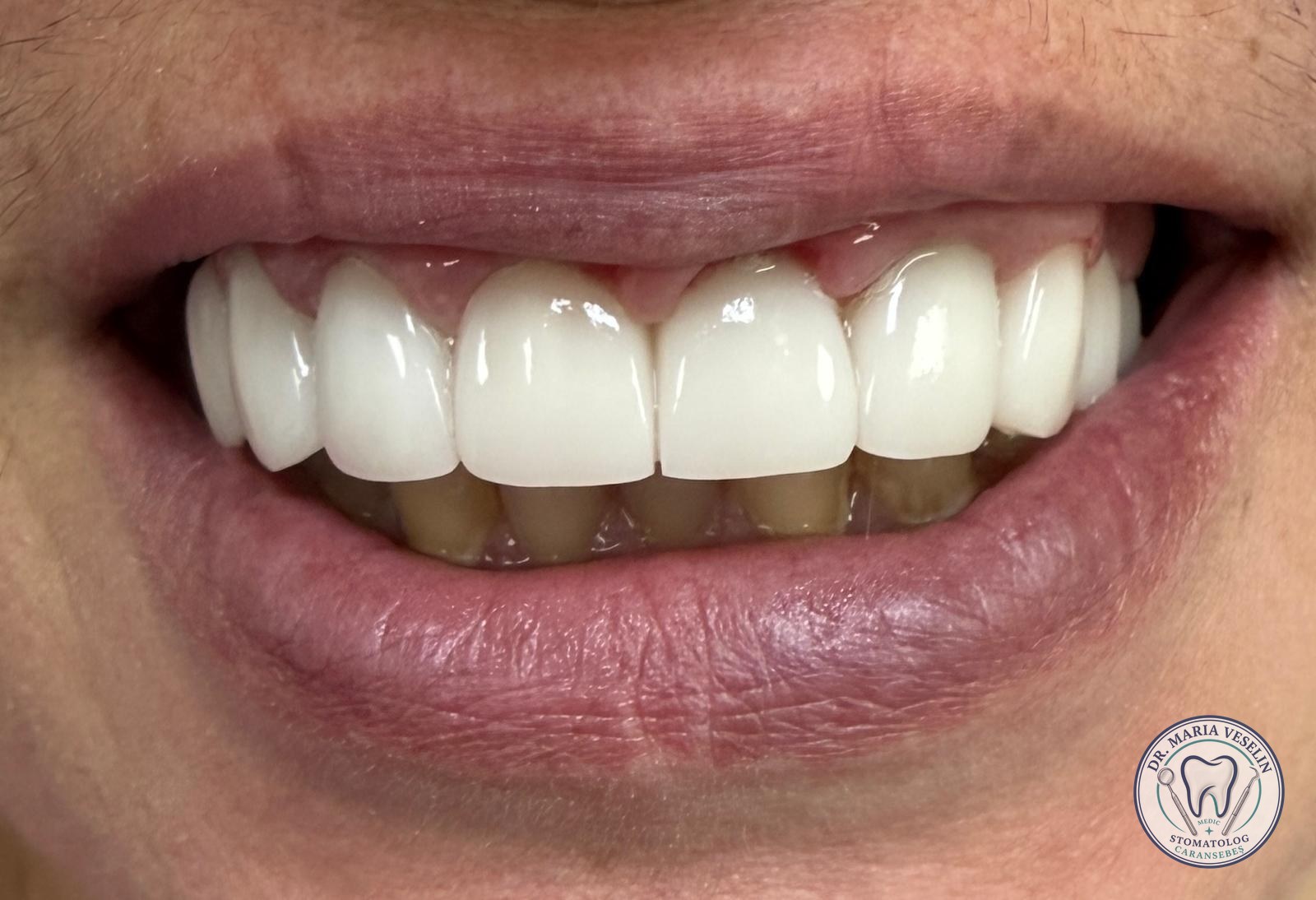 Etapa 2 din reabilitarea estetica cu lucrare din zirconiu la Dental Maria Veselin Caransebes