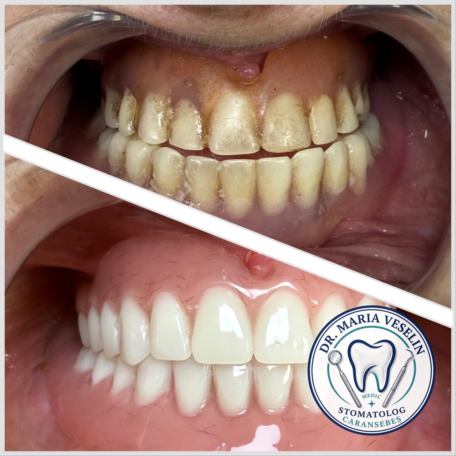 Proteza termoplastica frontala - restaurare protetica mobila, inainte si dupa, Dental Maria Veselin