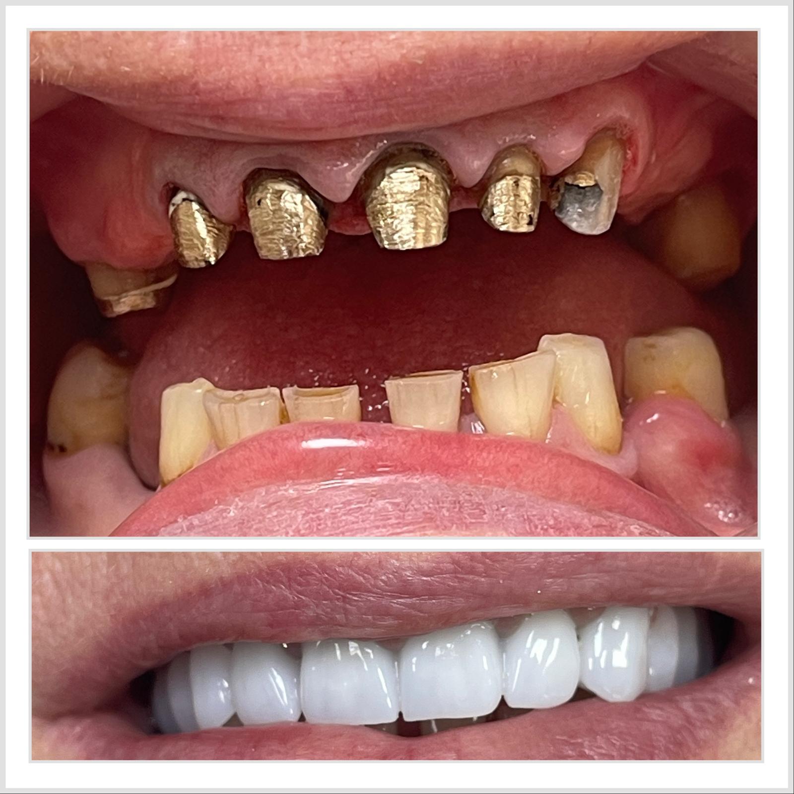Caz 3 — Coroane integral ceramice: rezultat inainte si dupa la cabinetul Dental Maria Veselin