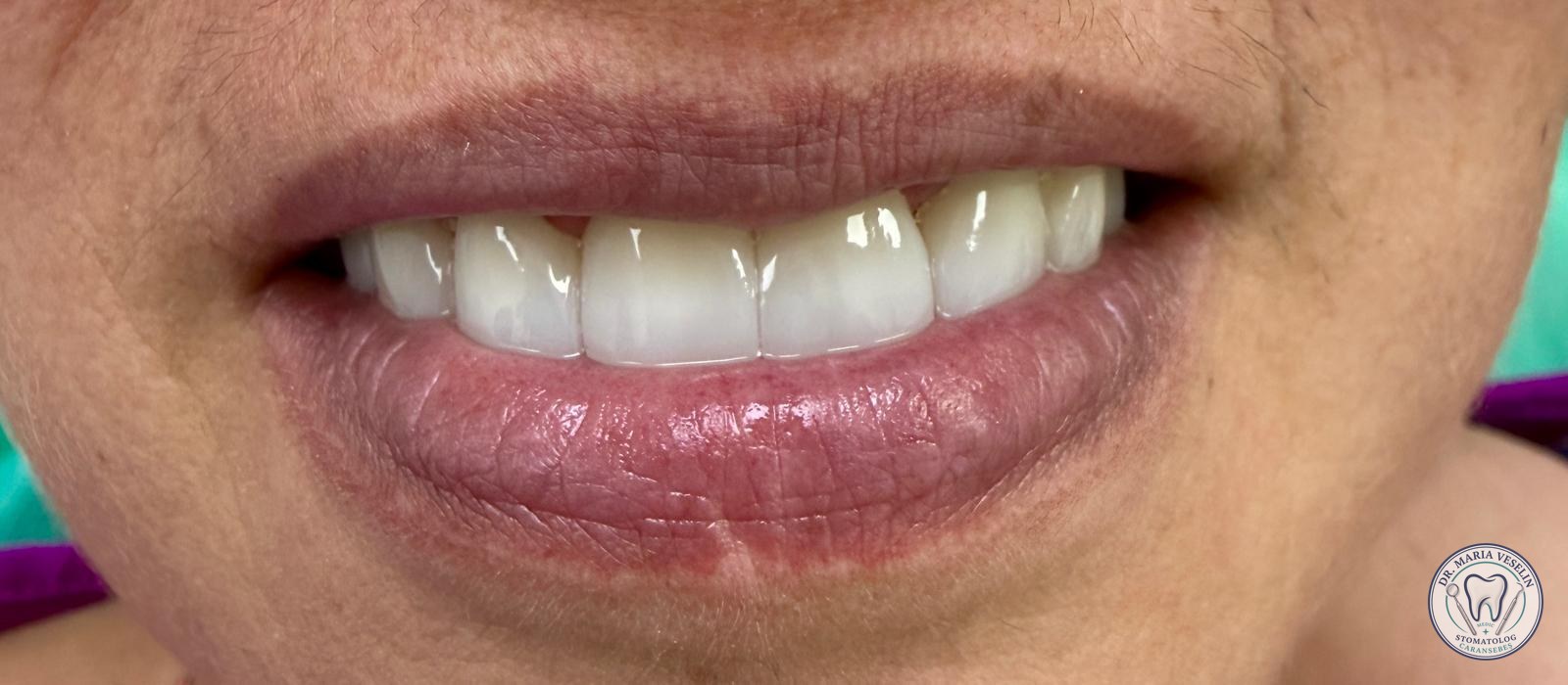 Etapa 4 din reabilitarea estetica cu lucrare din zirconiu la Dental Maria Veselin Caransebes