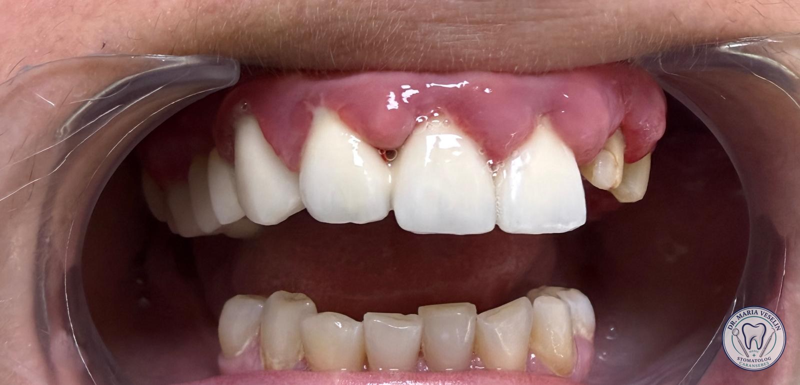 Situatia initiala 2: vechea lucrare protetica si conturul gingival neuniform, inainte de tratament la Dental Maria Veselin