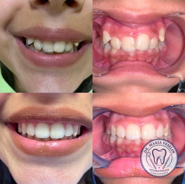 Inghesuire dentara corectata cu aparat ortodontic - zambet aliniat, Caransebes