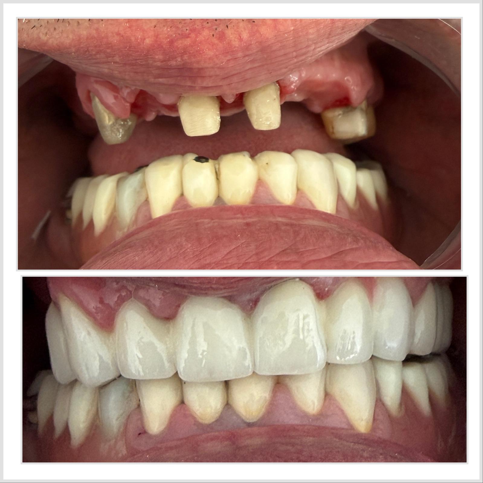 Caz 4 — Lucrare protetica fixa: rezultat inainte si dupa la cabinetul Dental Maria Veselin
