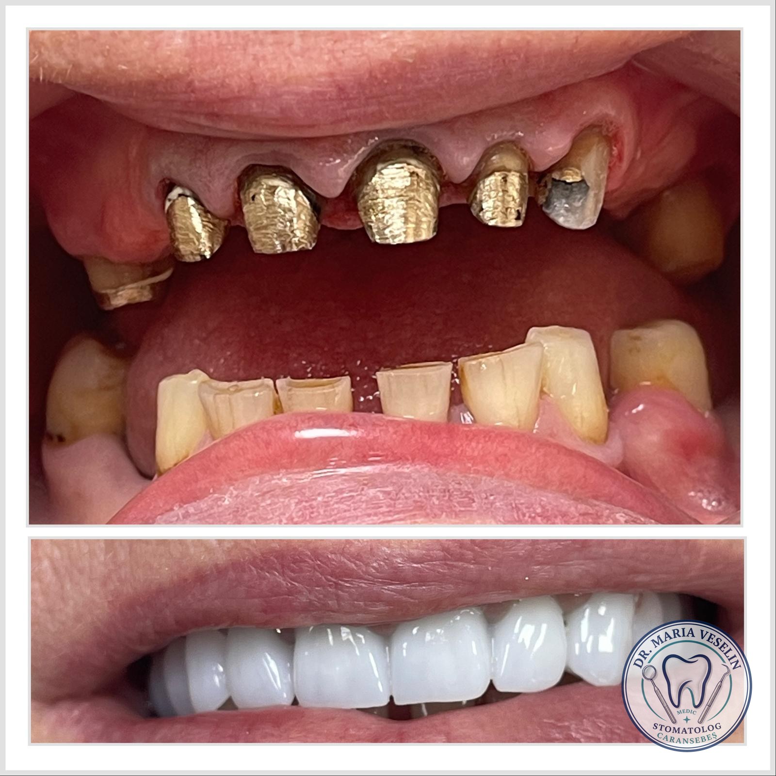 Coroane integral ceramice pe dintii frontali - rezultat estetic natural, Dental Maria Veselin