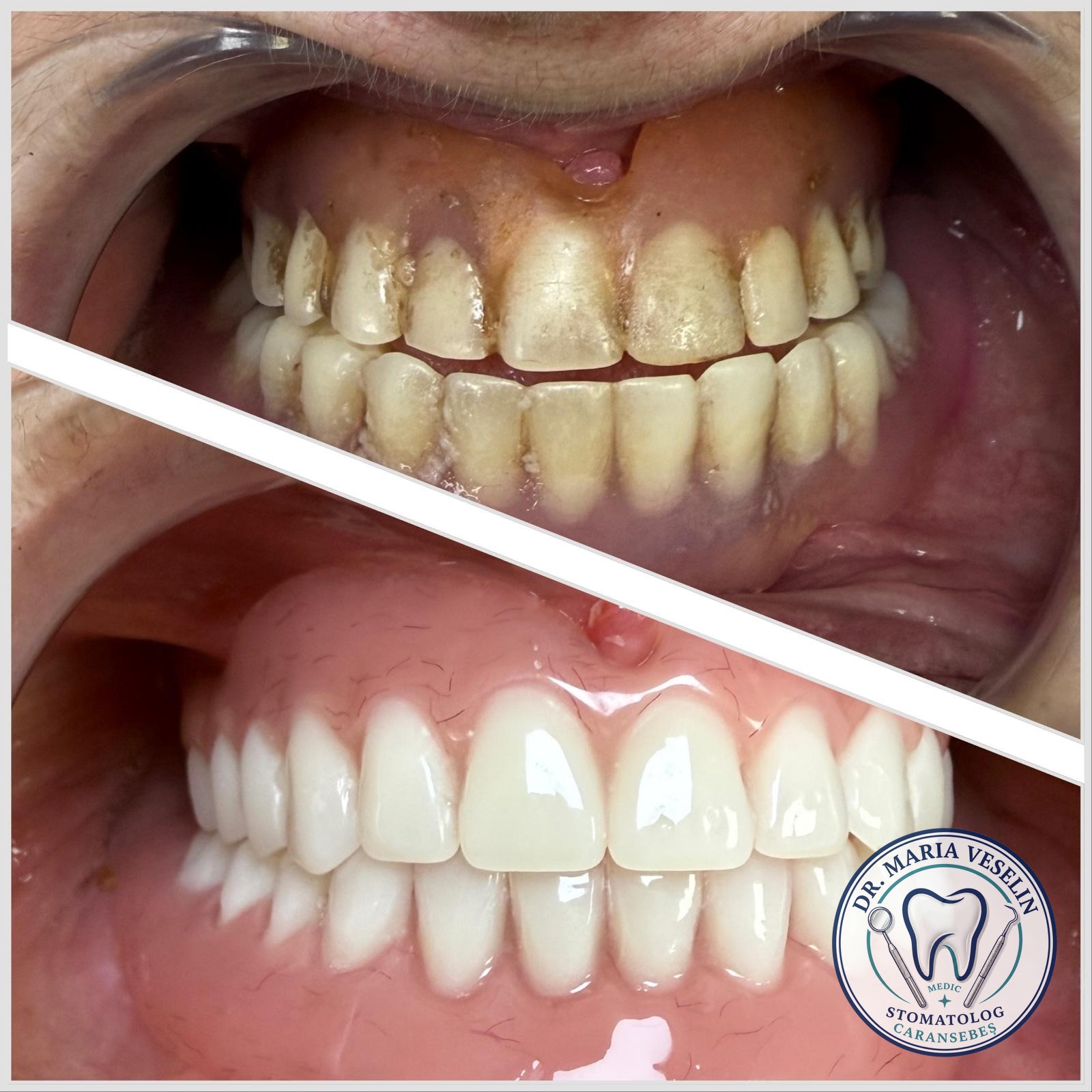 Rezultat frontal inainte si dupa tratamentul cu proteze termoplastice elastice la Dental Maria Veselin Caransebes