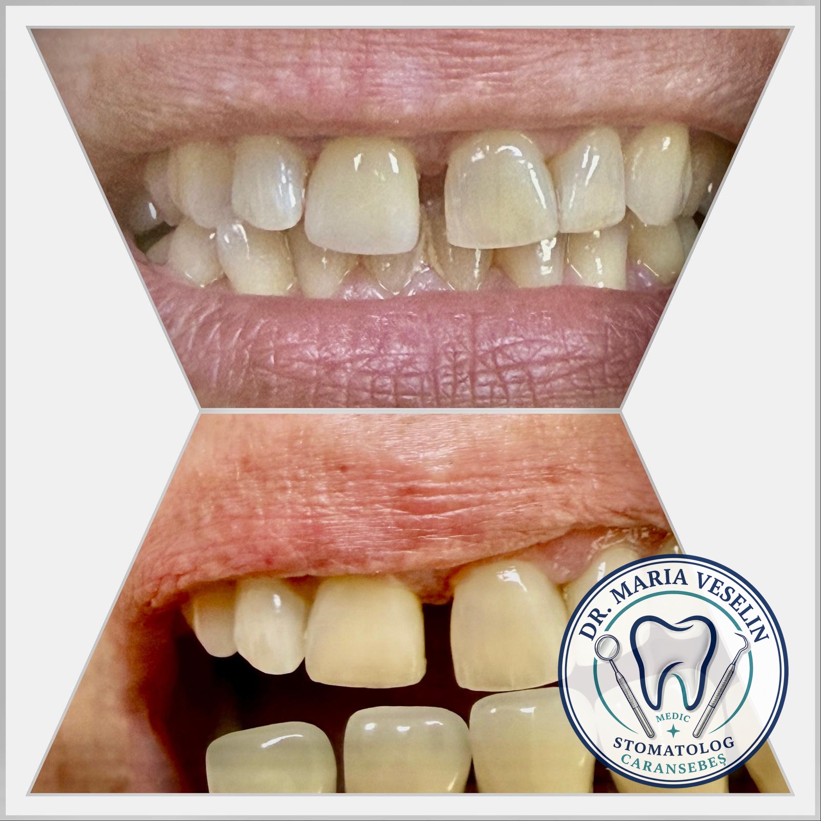 Feteta dentara - rezultat estetic inainte si dupa la Dental Maria Veselin Caransebes