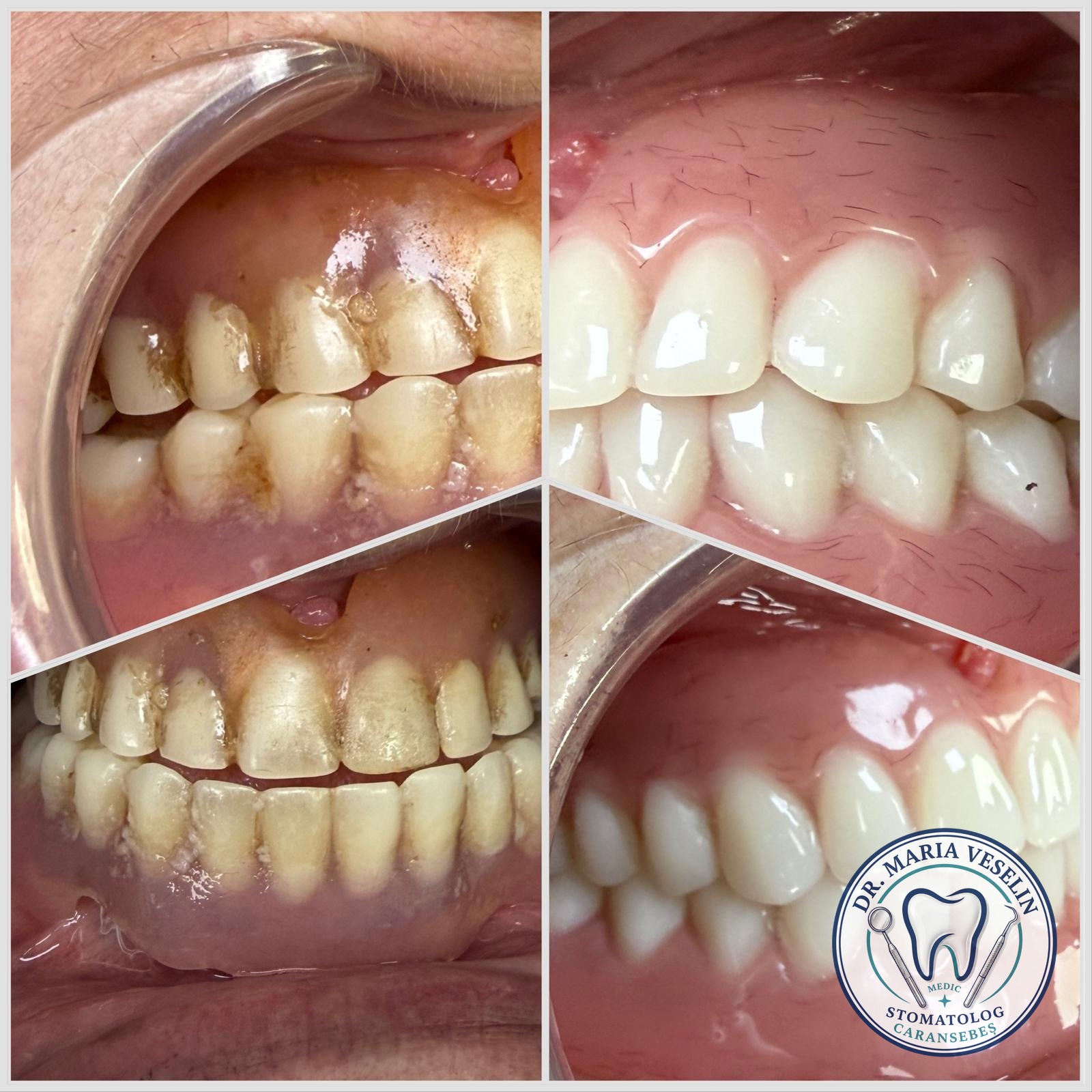 Comparatie inainte si dupa reechilibrarea functionala si estetica prin proteze elastice la Dental Maria Veselin Caransebes