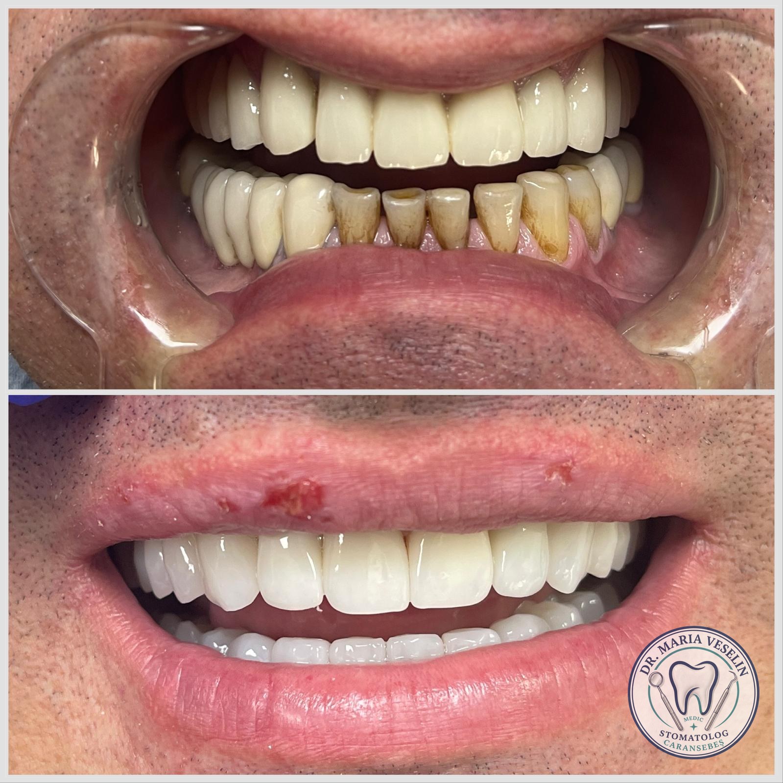 Reabilitare estetica completa a zambetului - rezultat inainte si dupa la Dental Maria Veselin Caransebes