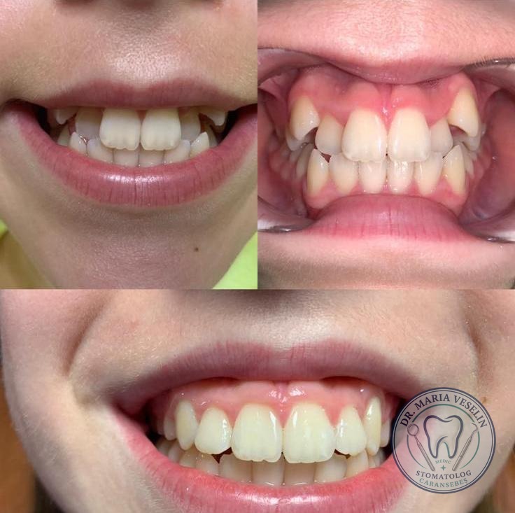 Tratament ortodontic cu aparat dentar - etape si aliniere finala, Dental Maria Veselin