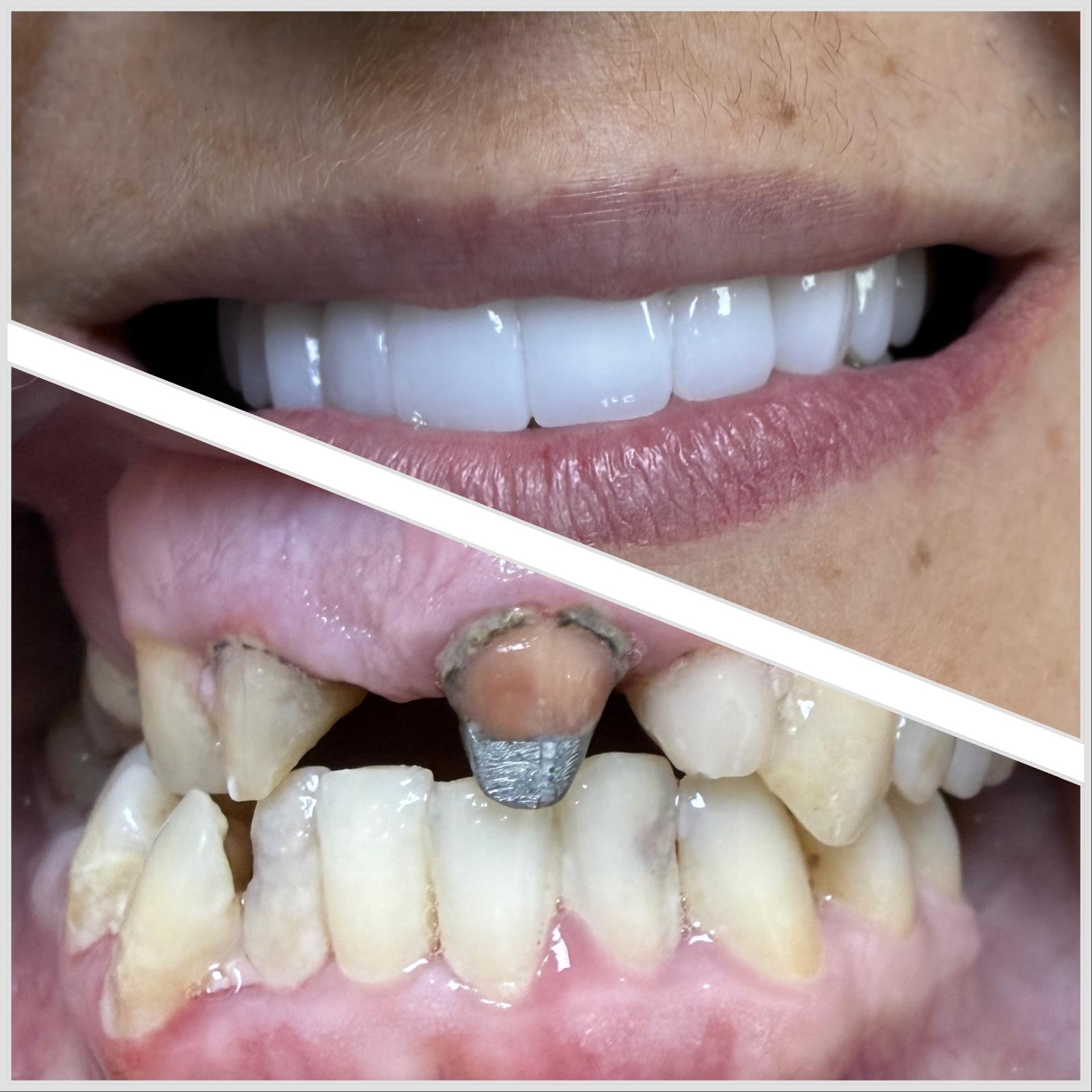 Caz 6 — Coroane de zirconiu: rezultat inainte si dupa la cabinetul Dental Maria Veselin