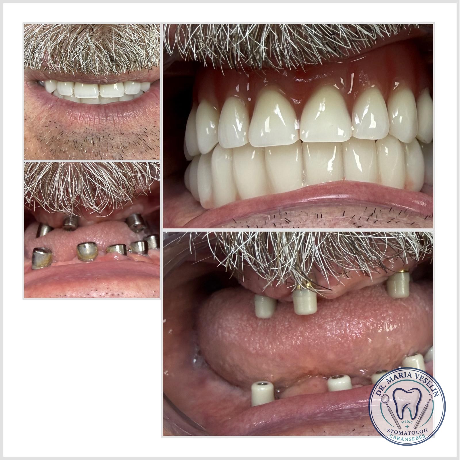 Reabilitare orala pe implanturi dentare - rezultat inainte si dupa, Dental Maria Veselin