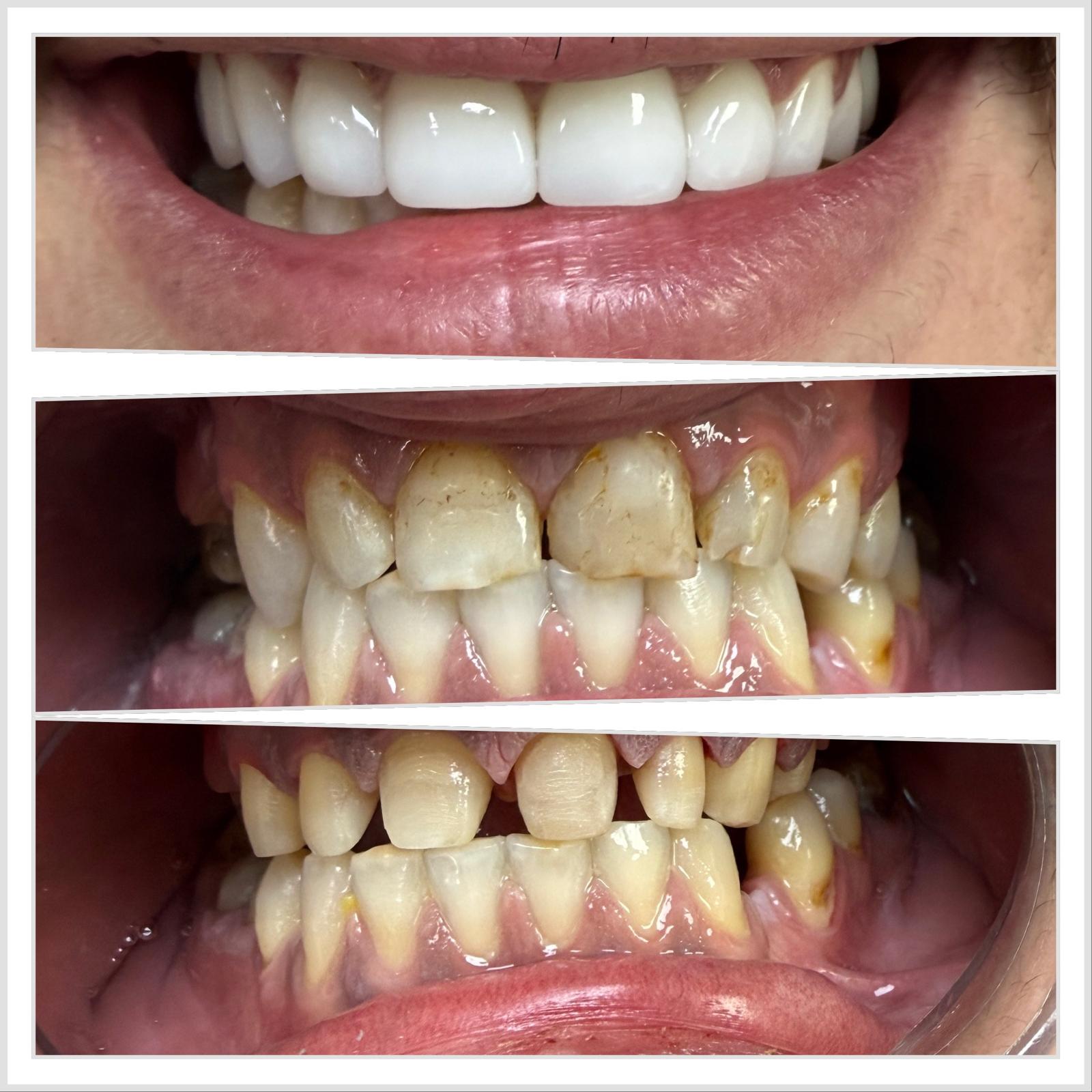 Caz 10 — Tratament parodontal si estetic: rezultat inainte si dupa la cabinetul Dental Maria Veselin