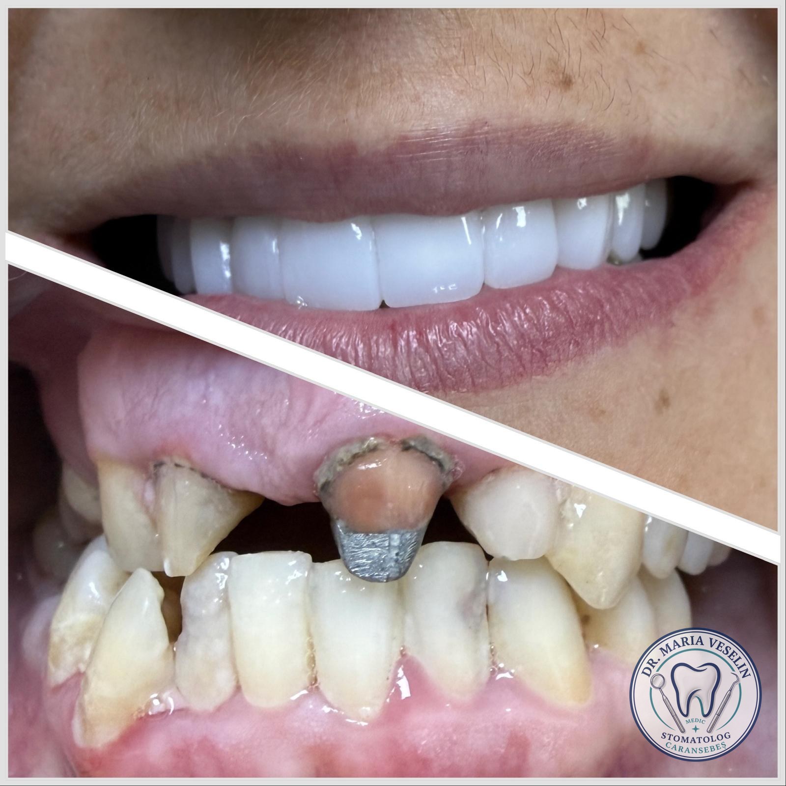 Lucrare extinsa cu coroane de zirconiu - reabilitare protetica la Dental Maria Veselin
