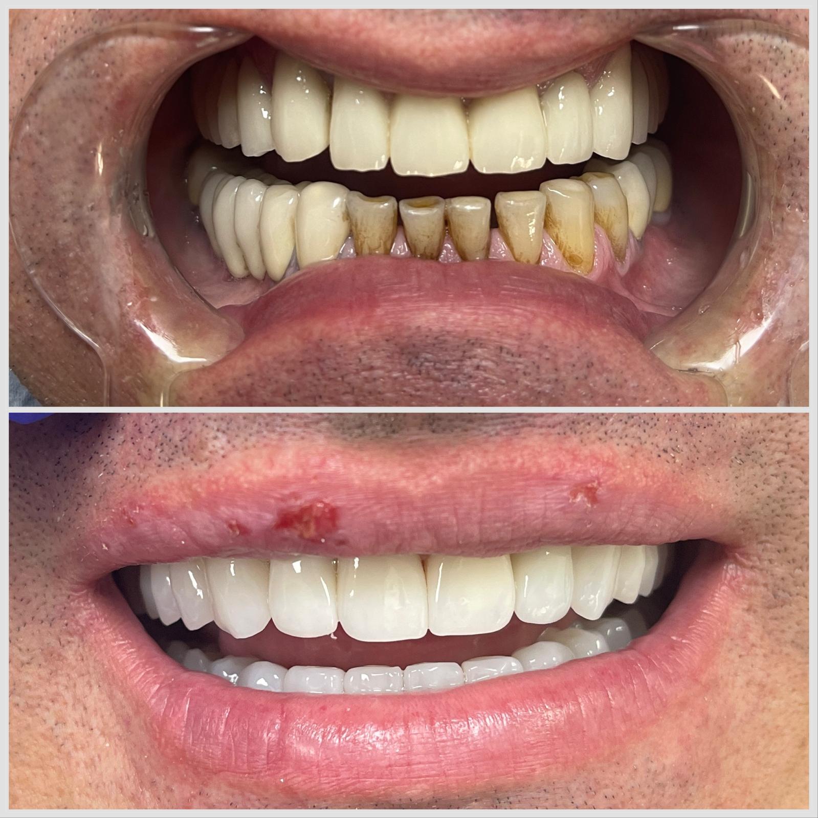 Caz 1 — Reabilitare estetica completa: rezultat inainte si dupa la cabinetul Dental Maria Veselin