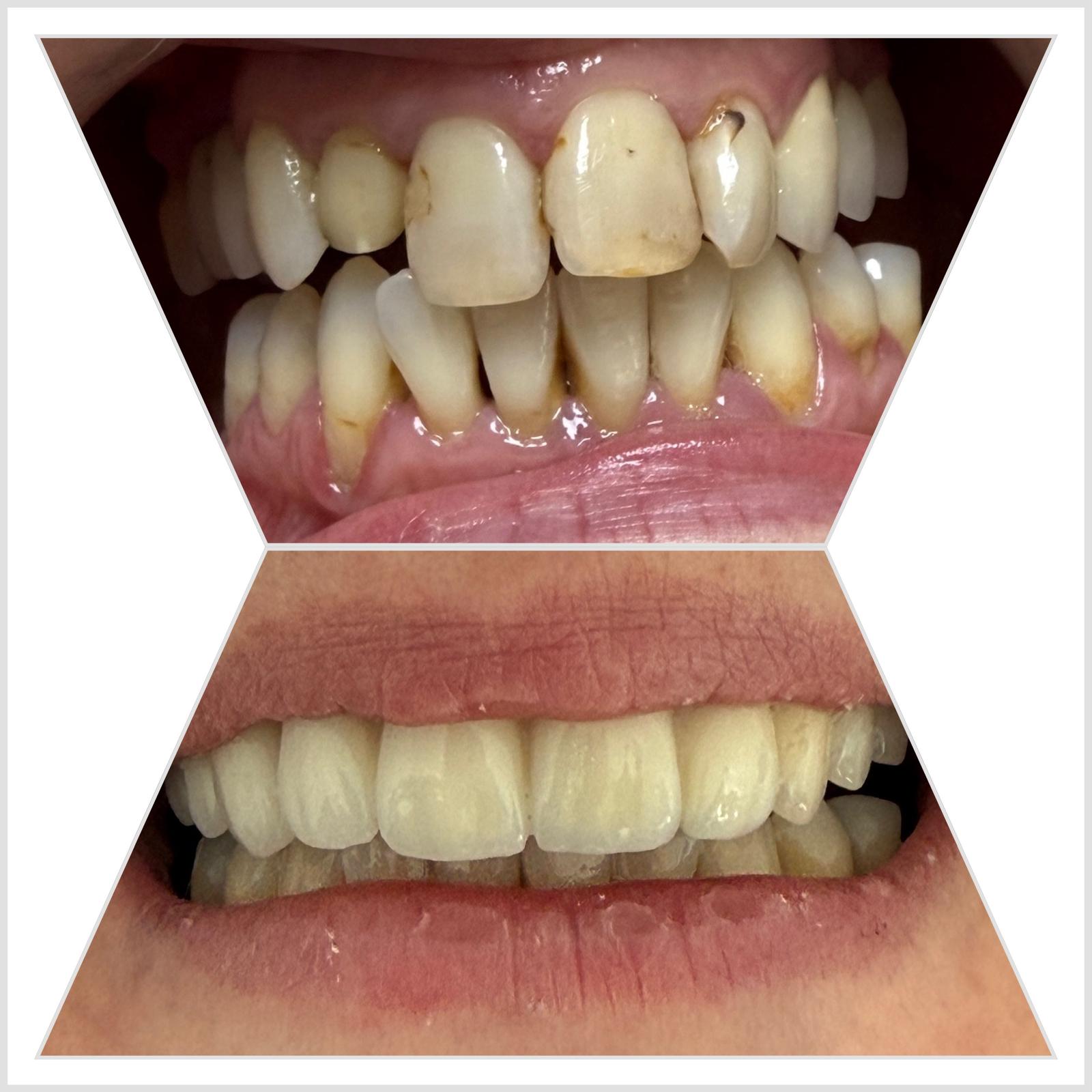 Caz 5 — Coroane de zirconiu: rezultat inainte si dupa la cabinetul Dental Maria Veselin