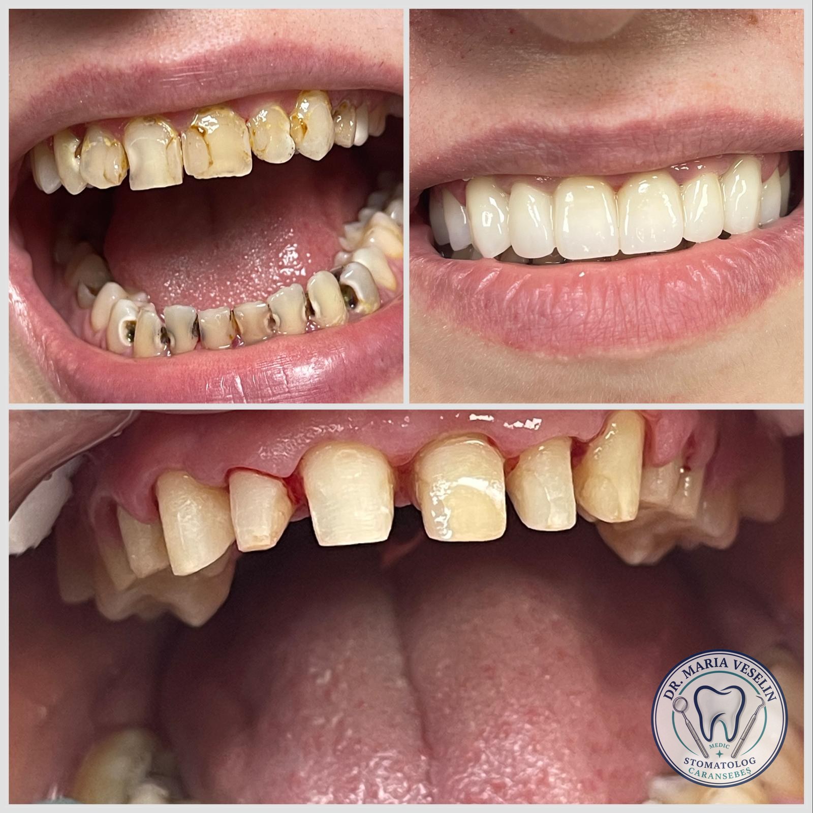 Restaurari dentare si igienizare profesionala - dinti curatati si obturatii fizionomice, Caransebes
