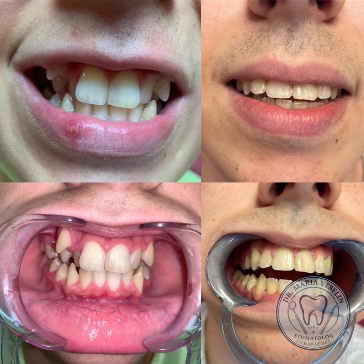 Corectarea dintilor inghesuiti cu aparat dentar fix - rezultat inainte si dupa, Caransebes