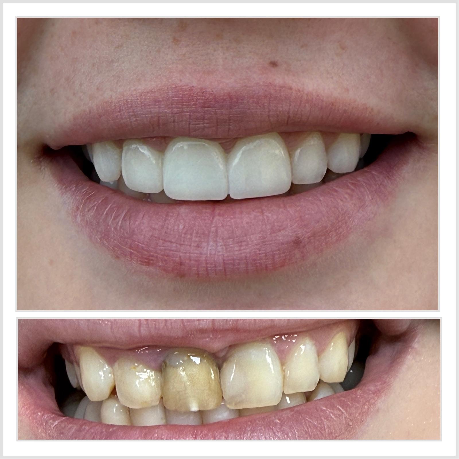 Caz 7 — Fatete ceramice frontale: rezultat inainte si dupa la cabinetul Dental Maria Veselin