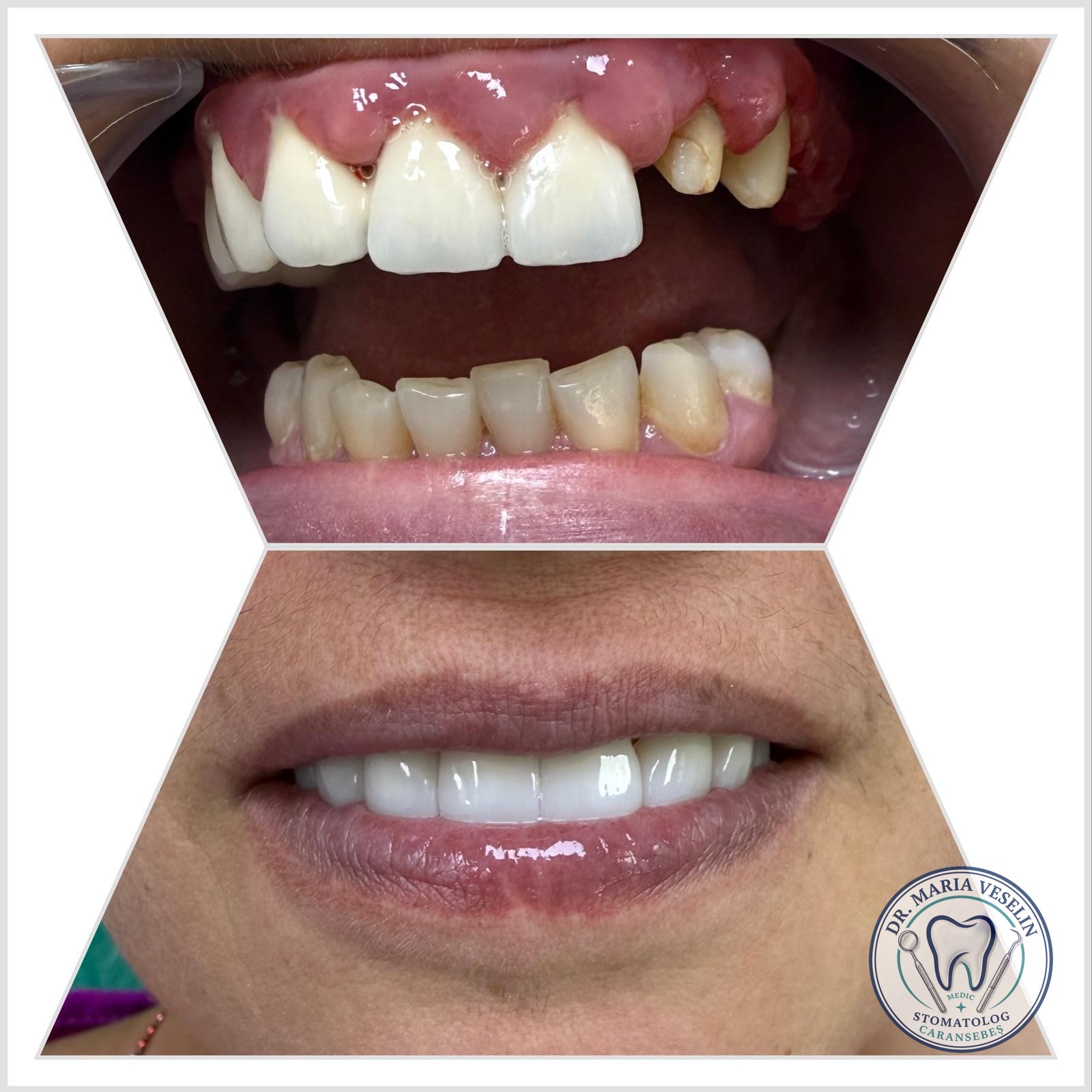Reabilitare estetica cu lucrare fixa din zirconiu - inainte si dupa, Dental Maria Veselin Caransebes