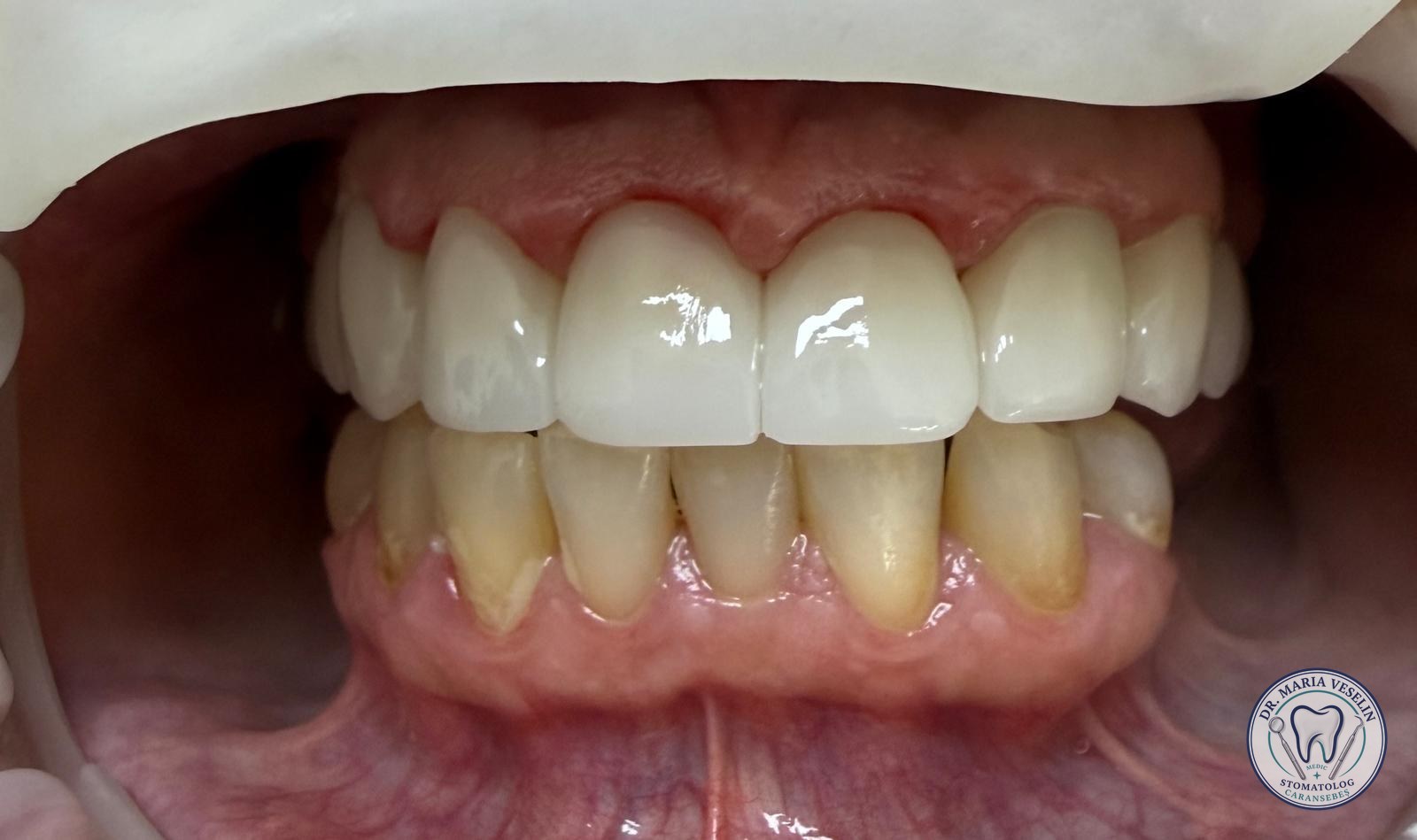 Etapa 3 din reabilitarea estetica cu lucrare din zirconiu la Dental Maria Veselin Caransebes