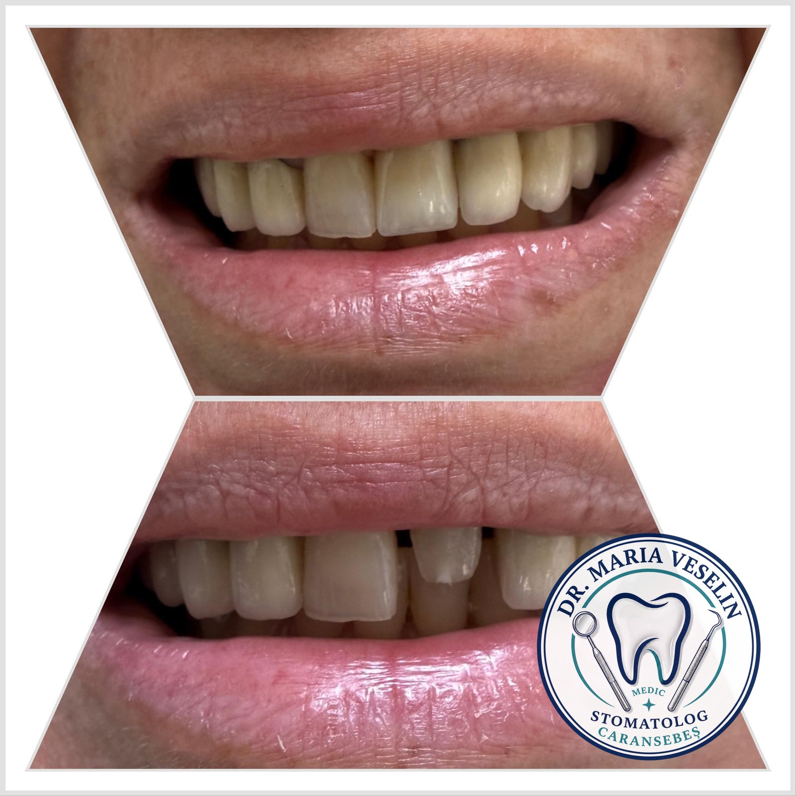 Reabilitare estetica frontala a zambetului - dinti restaurati, inainte si dupa, Dental Maria Veselin