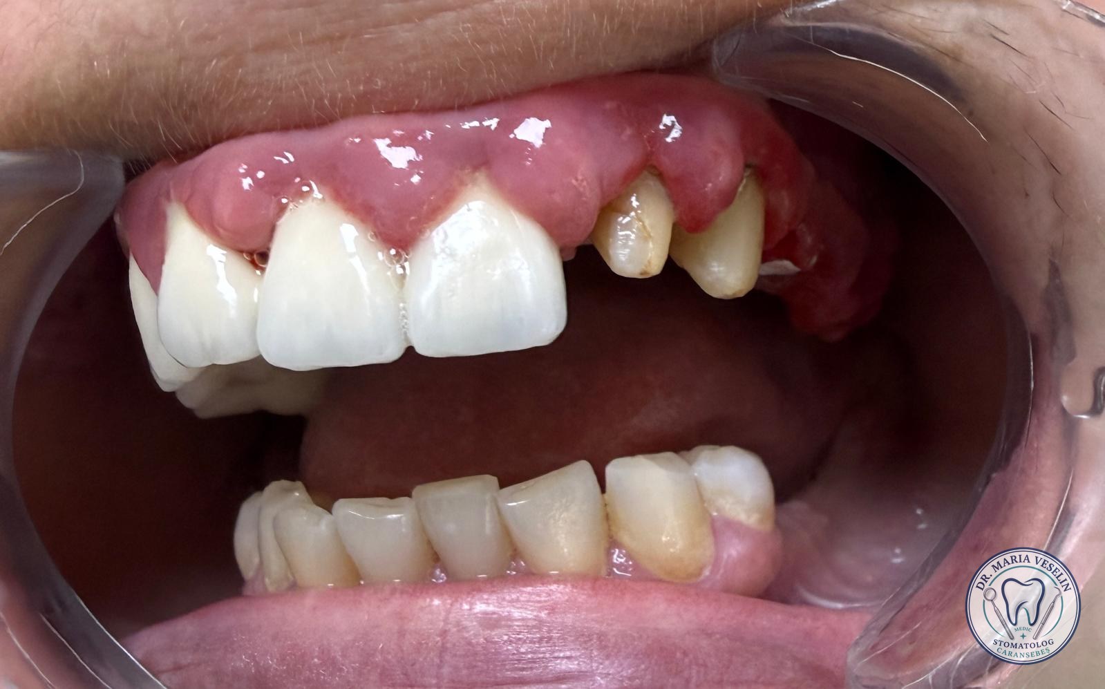 Situatia initiala 1: vechea lucrare protetica si conturul gingival neuniform, inainte de tratament la Dental Maria Veselin