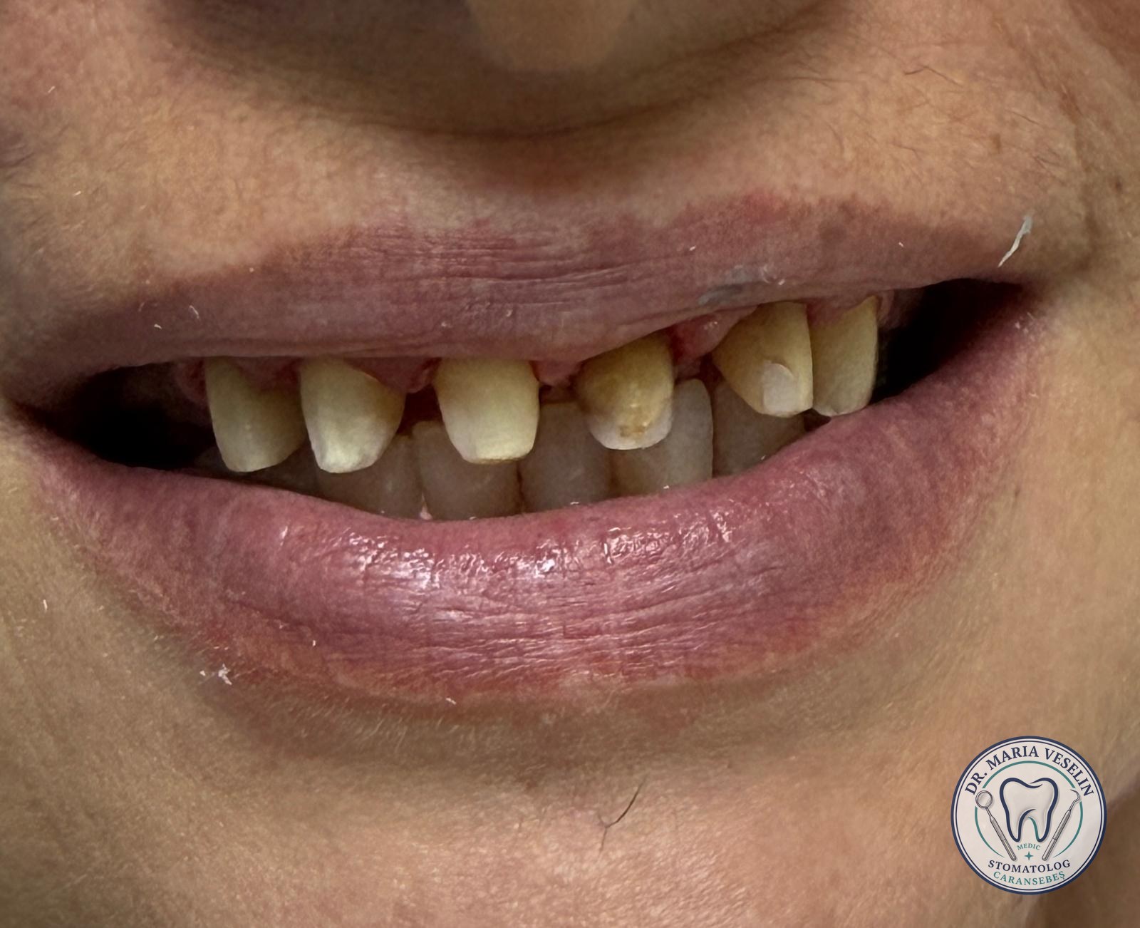 Etapa 1 din reabilitarea estetica cu lucrare din zirconiu la Dental Maria Veselin Caransebes