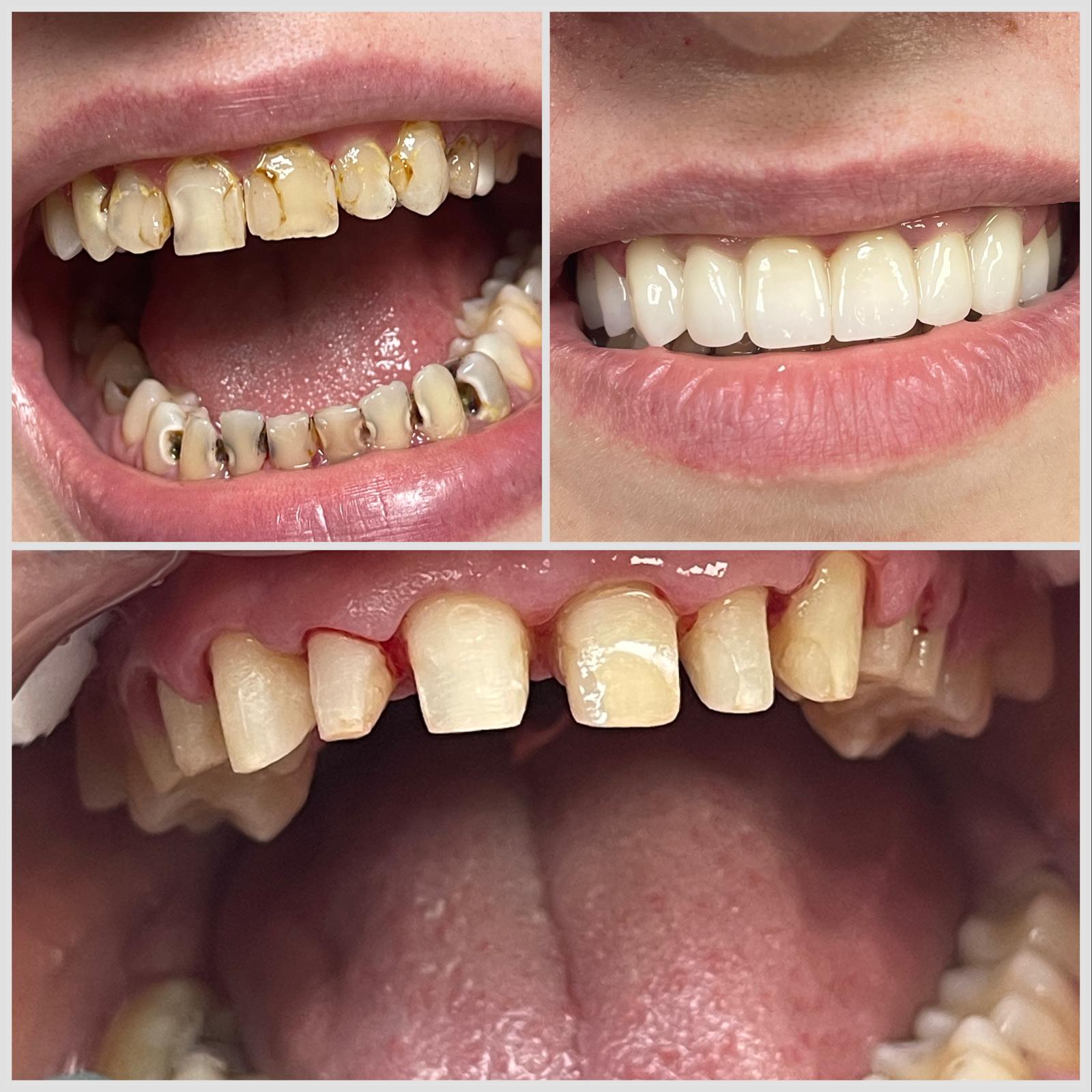 Caz 2 — Restaurari si igienizare profesionala: rezultat inainte si dupa la cabinetul Dental Maria Veselin