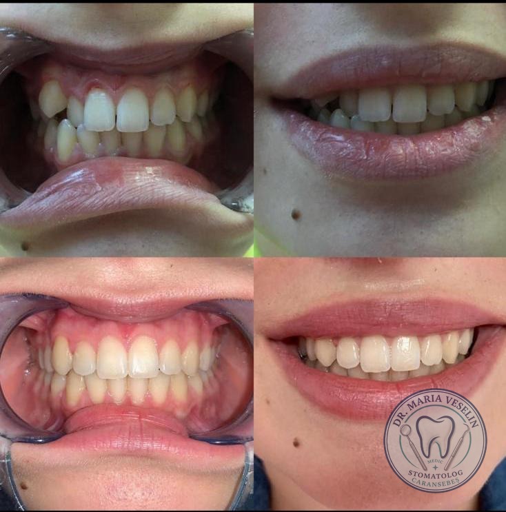 Aliniere dentara si estetica a zambetului - rezultat inainte si dupa la Dental Maria Veselin Caransebes